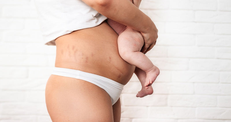 A woman with visible postpartum stretch marks on her abdomen holds a baby against a white brick wall background.